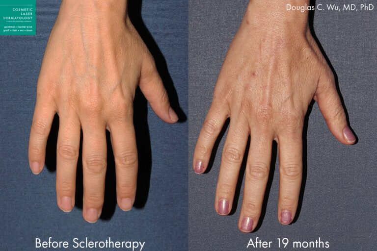 Sclerotherapy to treat hand veins by Dr. Wu. Treatment minimizes appearance of hand veins to make hands look more youthful.