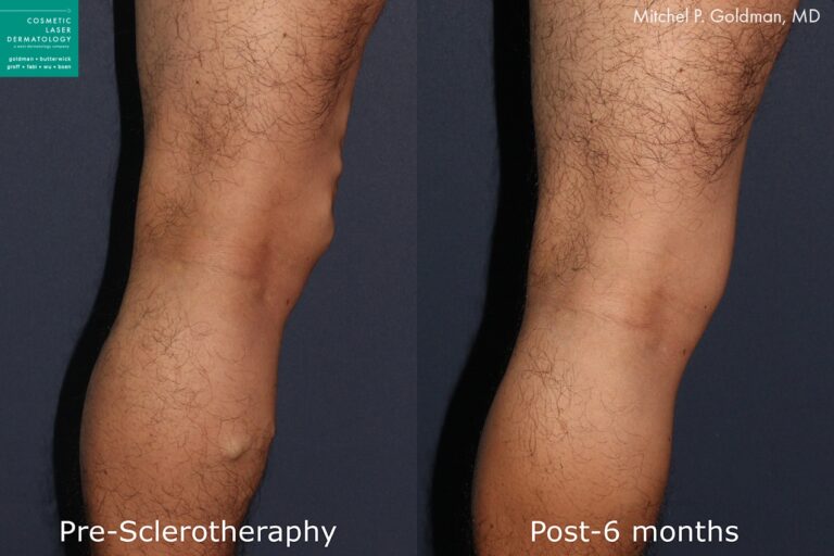 Sclerotherapy to treat leg veins by Dr. Goldman. After treatment, bulging veins are gone and legs are smoother and clearer.