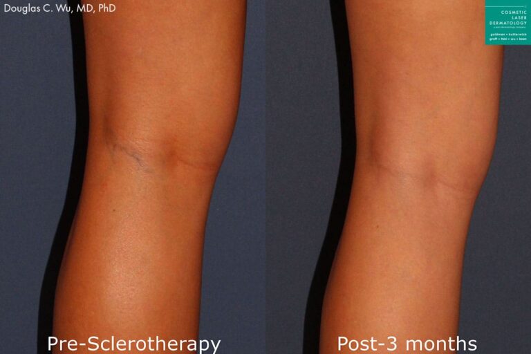 Sclerotherapy to remove visible leg veins by Dr. Wu. After treatment, vein is no longer apparent.