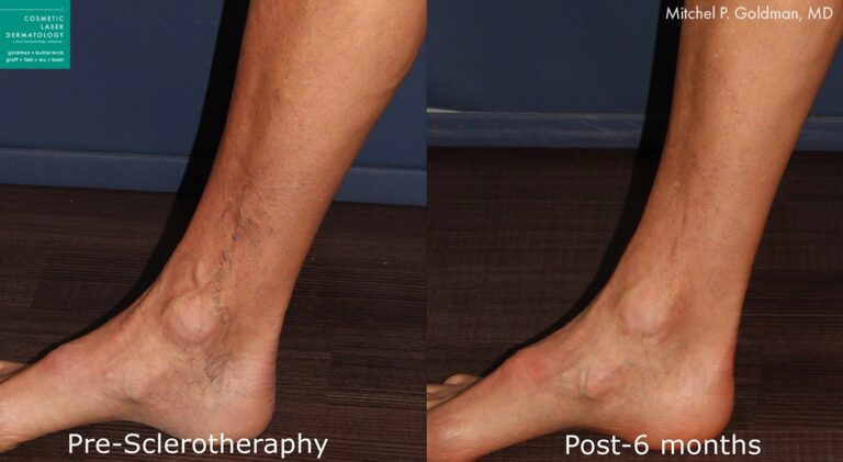 Sclerotherapy to treat varicose veins by Dr. Goldman. Treatment removes visible, bulging veins around the ankle.