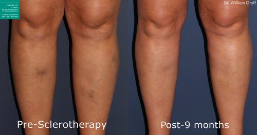 Sclerotherapy to remove visible spider veins by Dr. Groff. After treatment, networks of blue veins are eliminated.