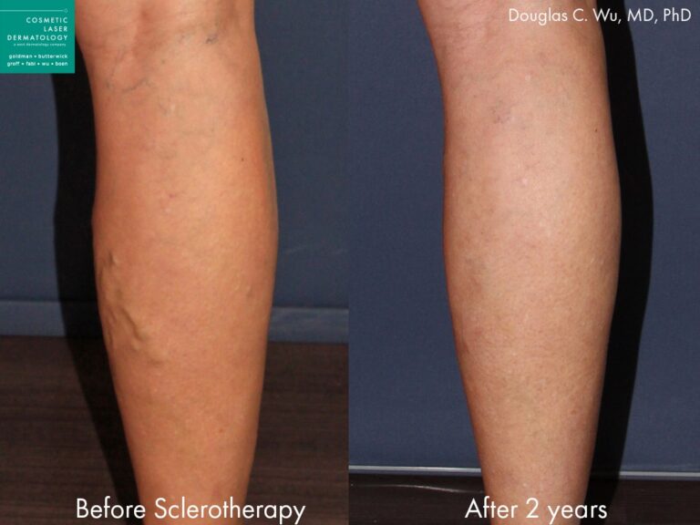 Sclerotherapy to treat varicose veins in the leg by Dr. Wu. Treatment removes visible, bulging veins from calf.