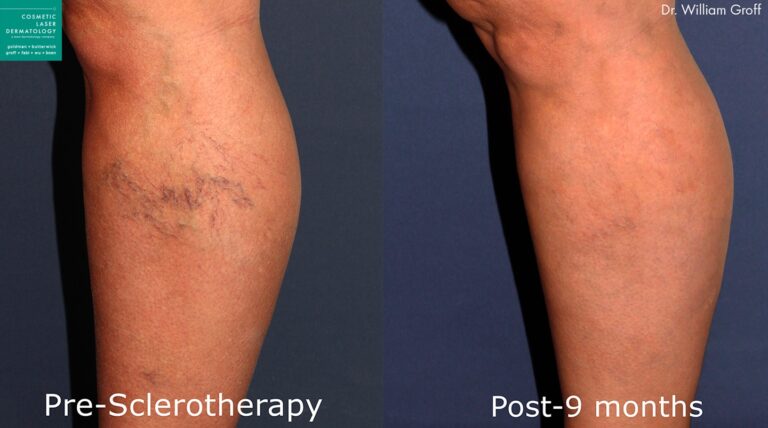Sclerotherapy to remove spider veins by Dr. Groff. Treatment removes networks of blue veins on the side of the calf.