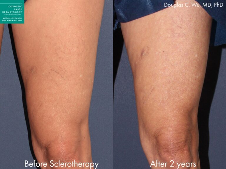 Sclerotherapy to treat leg veins by Dr. Wu. Treatment removes visible veins to create smoother thigh.