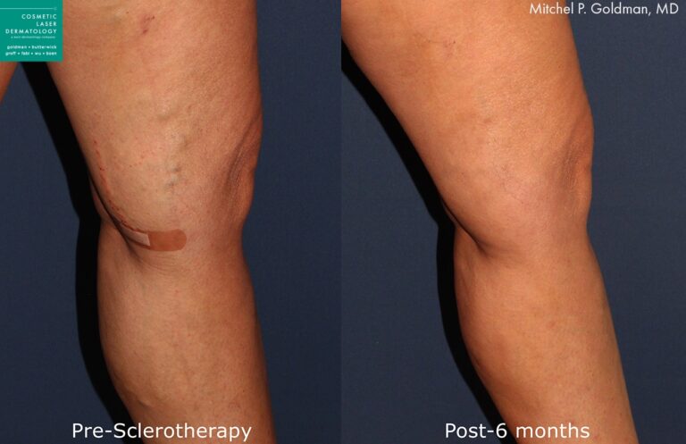 Sclerotherapy to treat visible leg veins by Dr. Goldman. Treatment removes visible, bulging veins for smoother, clearer skin.