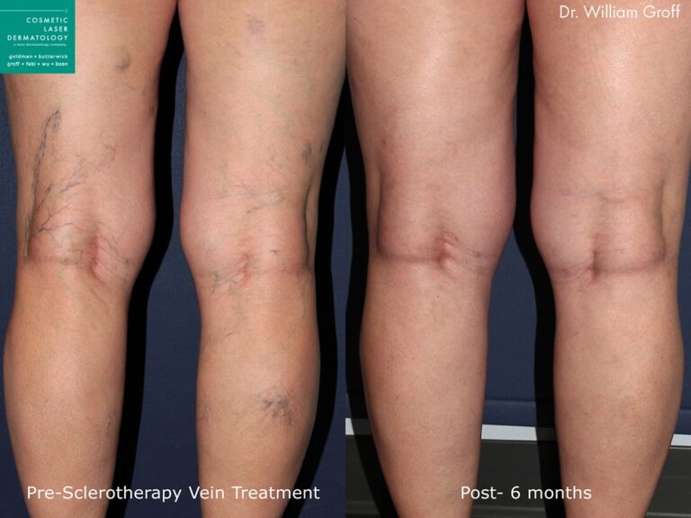 Sclerotherapy for leg veins by Dr. Groff. After treatment, visible veins are eliminated and skin looks clearer.