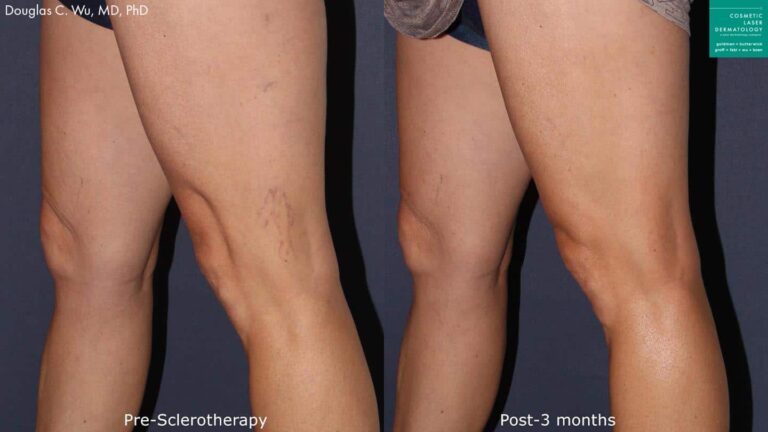 Sclerotherapy to remove leg veins by Dr. Wu. After the procedure, veins are no longer visible.