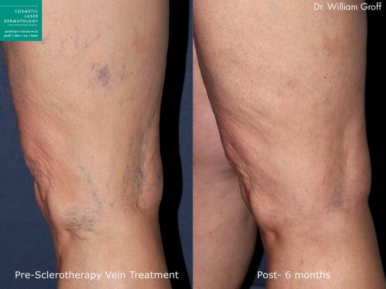 Sclerotherapy to treat leg veins by Dr. Groff. Treatment eliminates visible veins and produces clearer skin.