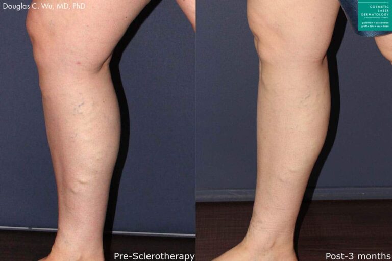 Sclerotherapy to remove bulging varicose veins from the leg by Dr. Wu. After treatment, visible veins are gone and surface of leg is smoother.