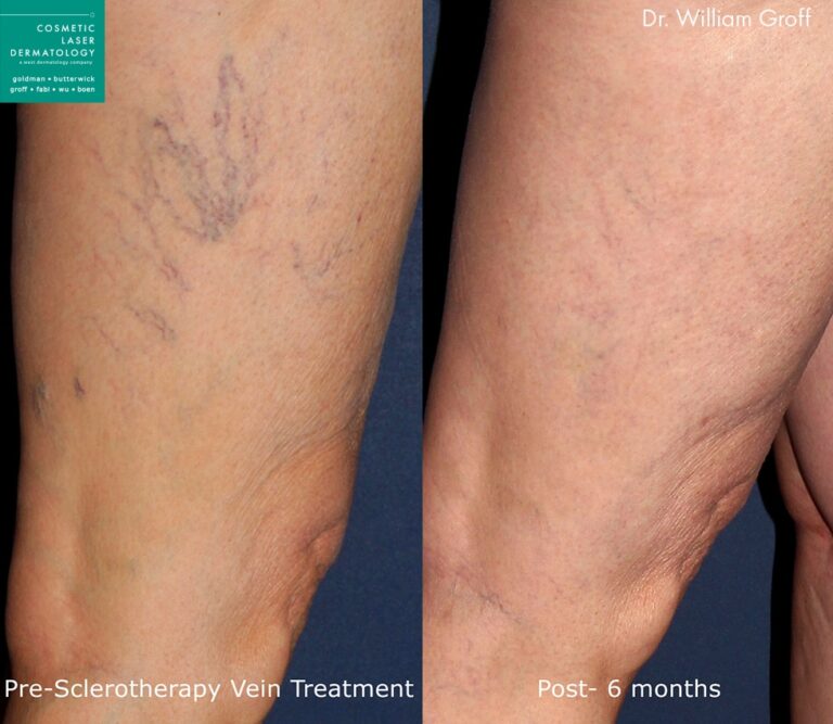 Sclerotherapy to treat veins on the leg by Dr. Groff. After treatment, visible veins are completely gone.