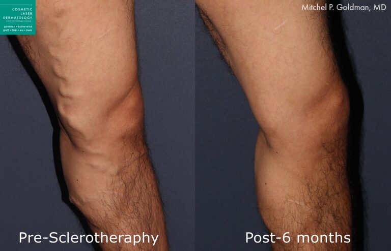 Sclerotherapy to treat varicose veins by Dr. Goldman. After treatment, bulging veins are gone and leg is smoother and clearer.