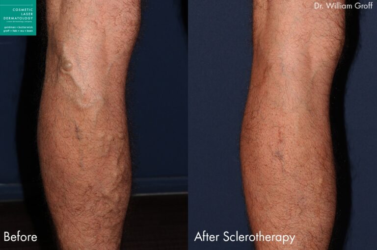 Sclerotherapy to treat leg veins by Dr. Groff. After treatment visible veins are gone and leg is smoother and clearer.