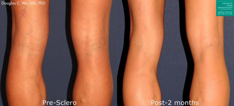 Sclerotherapy to treat leg veins by Dr. Wu. After treatment, visible leg veins are no longer evident.