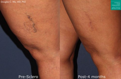 Sclerotherapy to treat leg veins by Dr. Wu. Treatment eliminates visible vein to produce clearer skin.