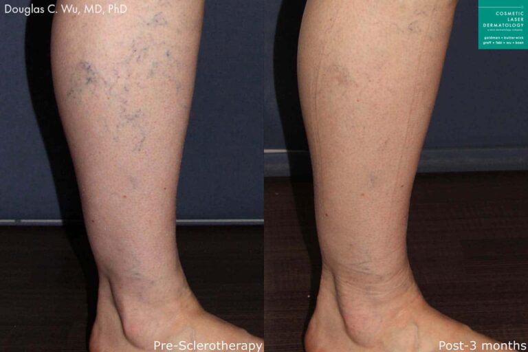 Sclerotherapy to treat visible leg veins by Dr. Wu. Treatment removes veins to produce clearer skin.