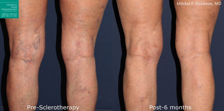 Sclerotherapy to treat visible veins by Dr. Goldman. Treatment removes veins from behind the knees to create clearer skin.