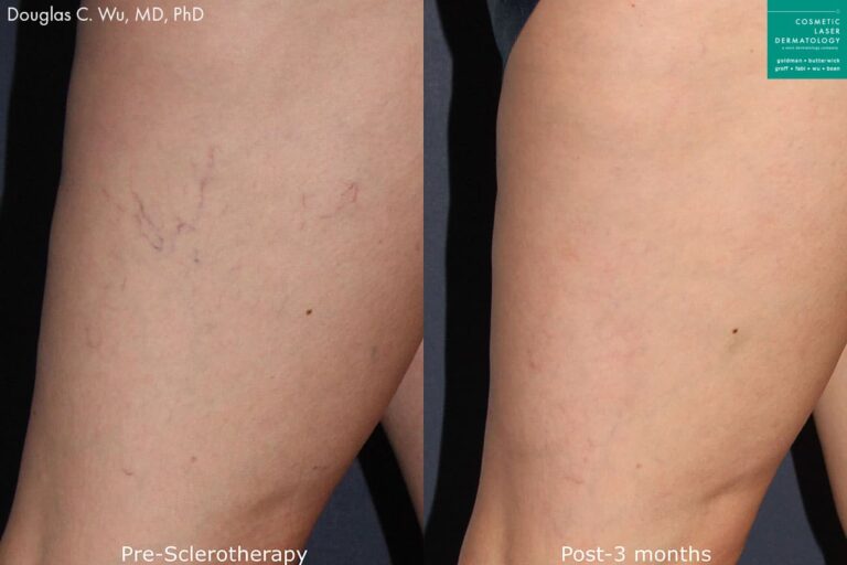 Sclerotherapy to treat leg veins by Dr. Wu. After treatment, visible veins are gone and skin is clearer.