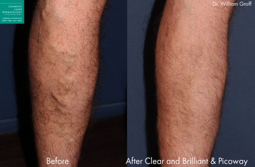 Sclerotherapy for leg veins by Dr. Groff. Treatment eliminates the bulging, visible veins on the calf.