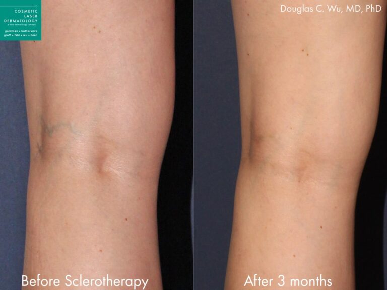 Sclerotherapy to treat leg veins by Dr. Wu. Treatment removes visible vein behind the knee.