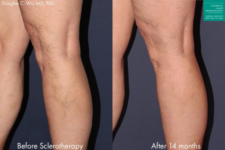 Sclerotherapy to treat spider veins on the leg by Dr. Wu. Treatment removes visible veins from side of calf.