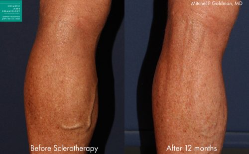 Sclerotherapy to treat varicose veins by Dr. Goldman. Treatment removes bulging vein to produce a smoother surface to the skin.