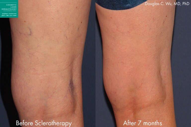Sclerotherapy to treat leg veins by Dr. Wu. Treatment removes dark cluster of veins behind the knee and other veins on the thigh.