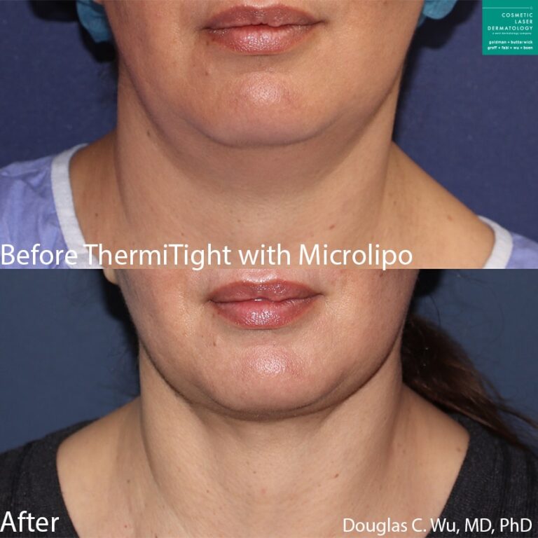ThermiTight and microlipo to remove submental fat and sculpt the jawline by Dr. Wu. Treatment removes pouch under the chin to improve the definition of the lower face.