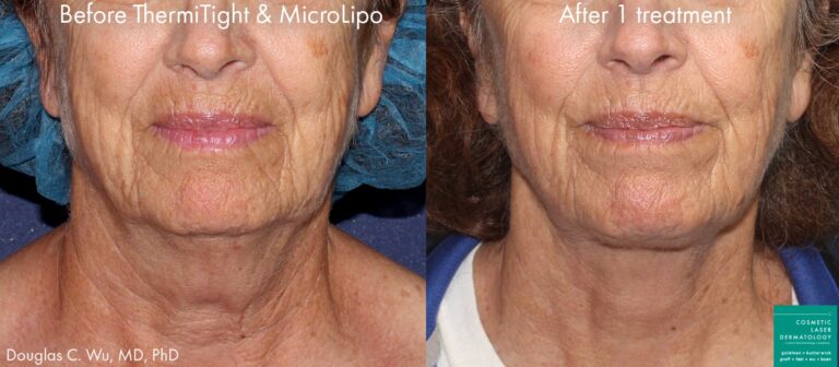 ThermiTight and microlipo to treat submental fat and tighten skin by Dr. Wu. Treatment removes fat pocket under the chin and tightens up skin for a better facial profile.