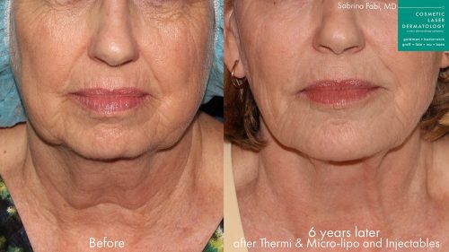 ThermiTight, micro-lipo, and injectables to rejuvenate lower face by Dr. Fabi. After treatment, jowls are visibly reduced and there are fewer lines and wrinkles in the lower face.