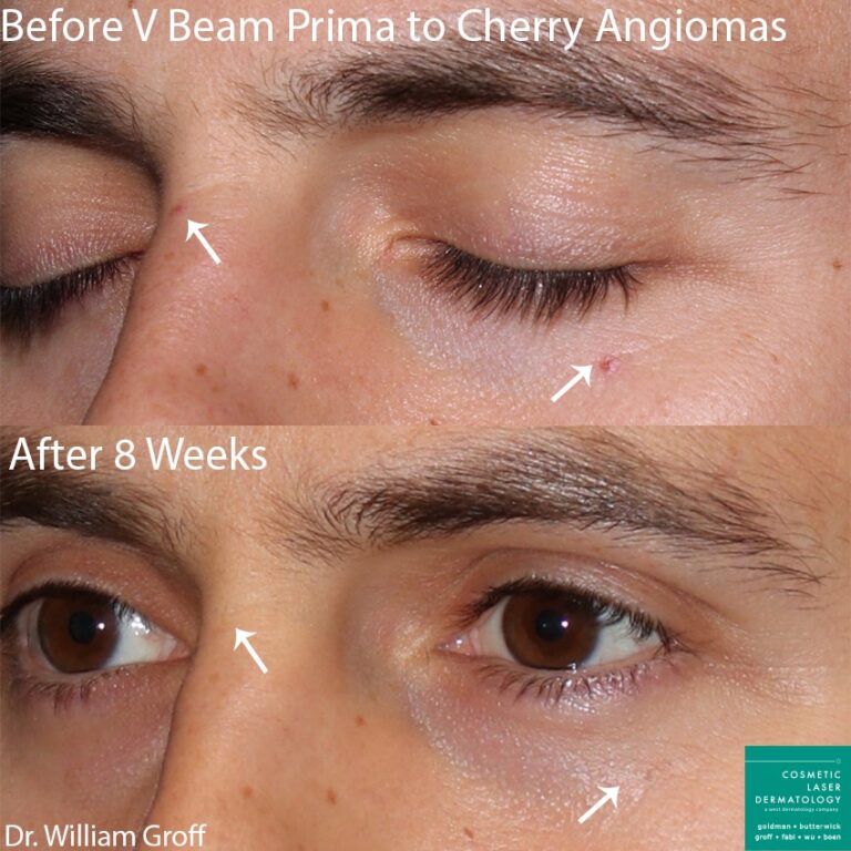 Vbeam Prima to treat cherry angiomas by Dr. Groff. After treatment, red spots are eliminated.