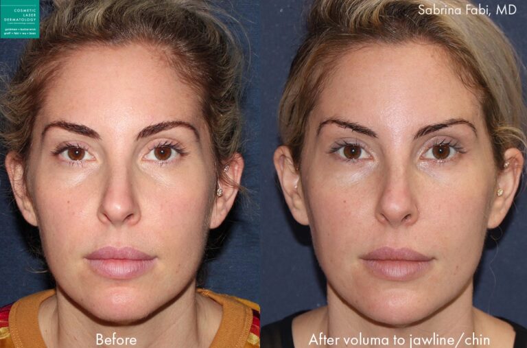 Voluma for jawline contouring by Dr. Fabi. Treatment creates subtle improvement and definition along the chin and jawline.