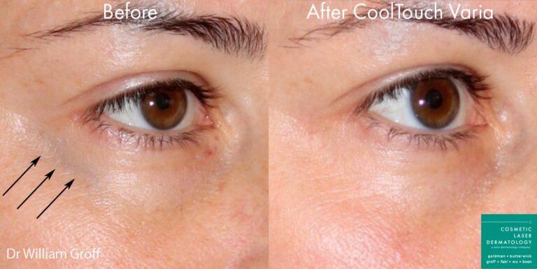CoolTouch Varia to remove eye veins from a female patient by Dr. Groff. After treatment, visible vein is gone.