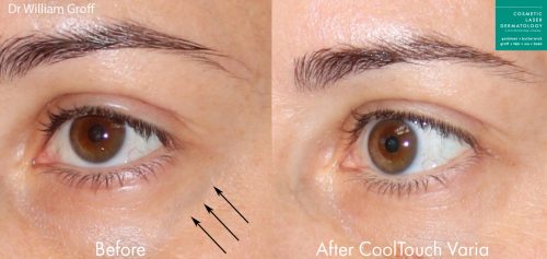 CoolTouch Varia to remove eye veins from a female patient by Dr. Groff. After treatment, visible vein is gone.