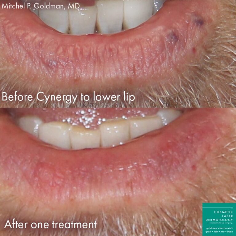 Cynergy laser to treat lesions on lower lip of male patient by Dr. Goldman. After treatment, lesions are nearly undetectable.