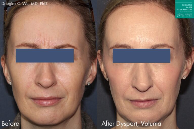 Dysport and Voluma for wrinkles and facial contouring of a female patient by Dr. Wu. After treatment, patient's facial shape is enhanced and wrinkles are visibly reduced.