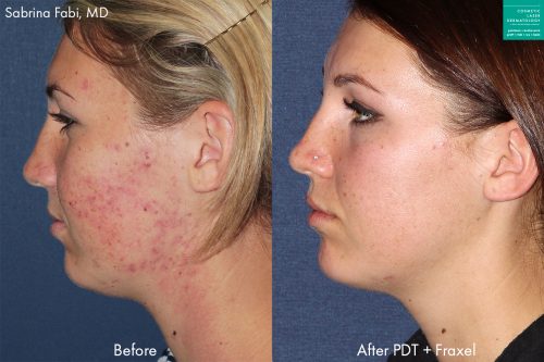 Laser acne treatment in san diego, ca