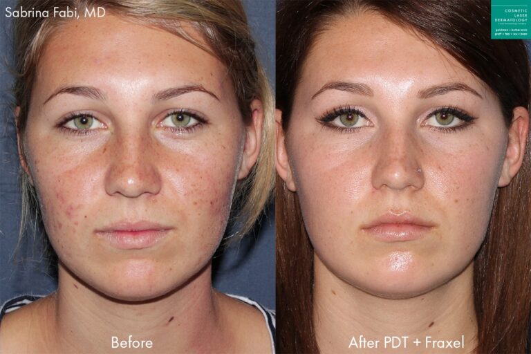 Fraxel and photodynamic therapy to treat acne on a female patient by Dr. Fabi. After treatments, skin is visibly clearer.