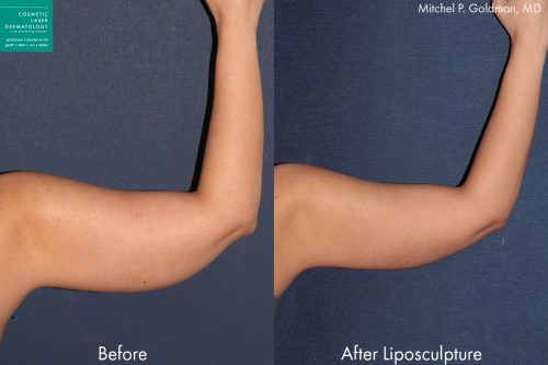 Liposuction to contour the upper arm of a female patient by Dr. Goldman. Treatment creates slimmer, firmer contour.