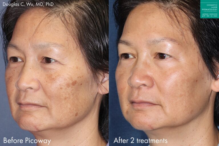 PicoWay laser to remove brown spots on a female patient by Dr. Wu. Treatment eliminates brown spots and sun damage.