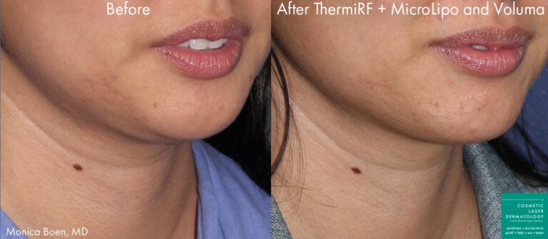 ThermiRF, microlipo, and Voluma to contour the chin of a female patient by Dr. Boen. Treatment removes submental fat and creates better definition to the jawline.