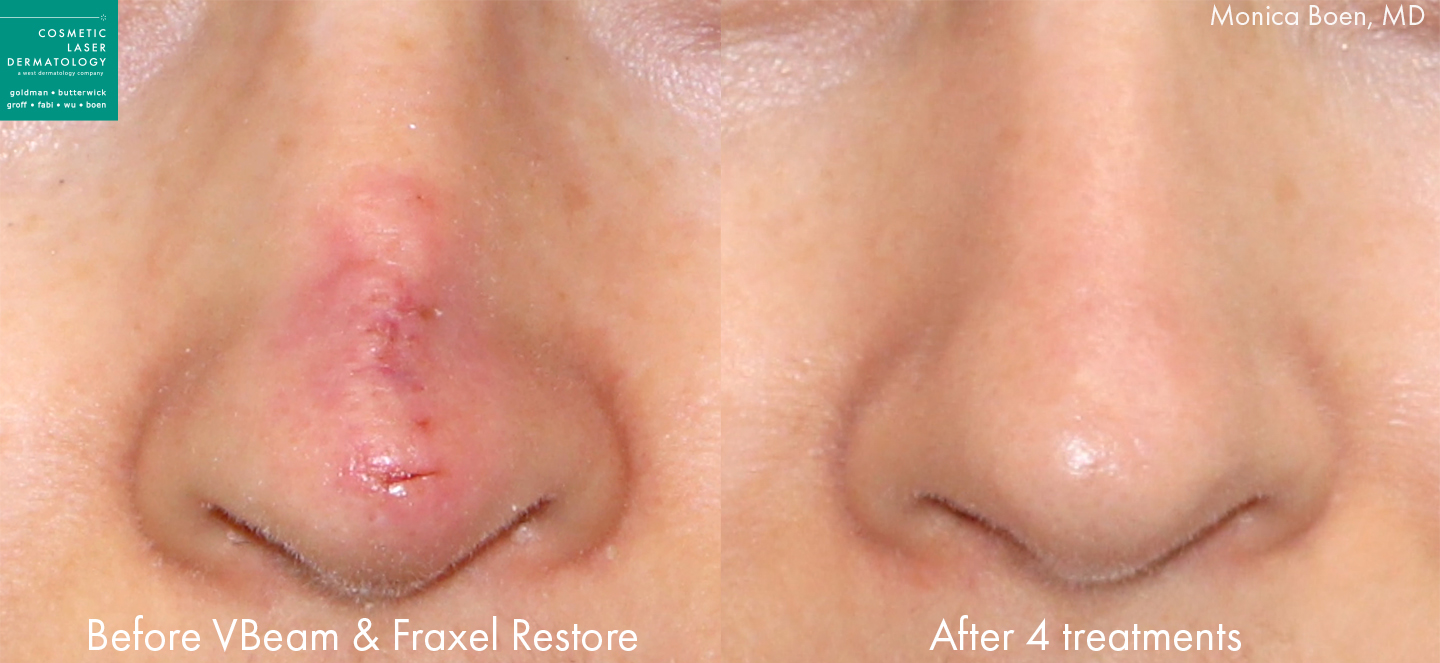 Before And After Photos San Diego Ca Cosmetic Laser Dermatology