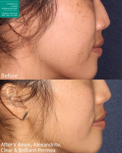 clear + brilliant facial laser in san diego, ca