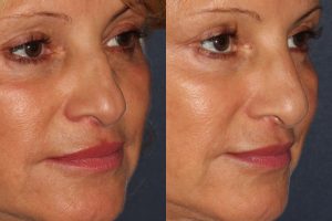 dermal fillers for a liquid facelift in san diego, ca