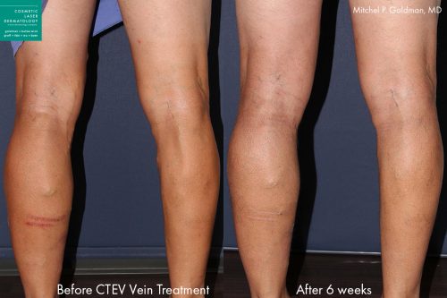 CTEV laser leg vein treatment in san diego, ca