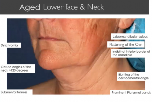 problems that aging neck causes