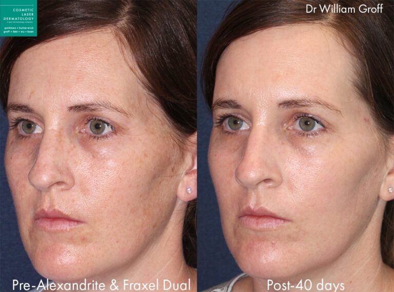 Fraxel Dual and Alexandrite lasers used to treat brown spots and rejuvenate the skin by Dr. Groff. After treatment, brown spots are visibly reduced.