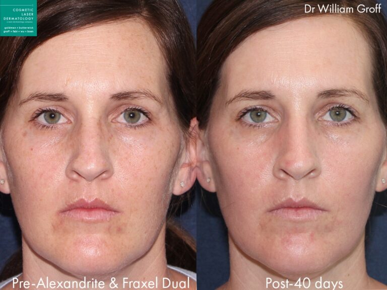 Fraxel Dual and Alexandrite lasers used to treat brown spots and rejuvenate the skin by Dr. Groff. After treatment, brown spots are visibly reduced.