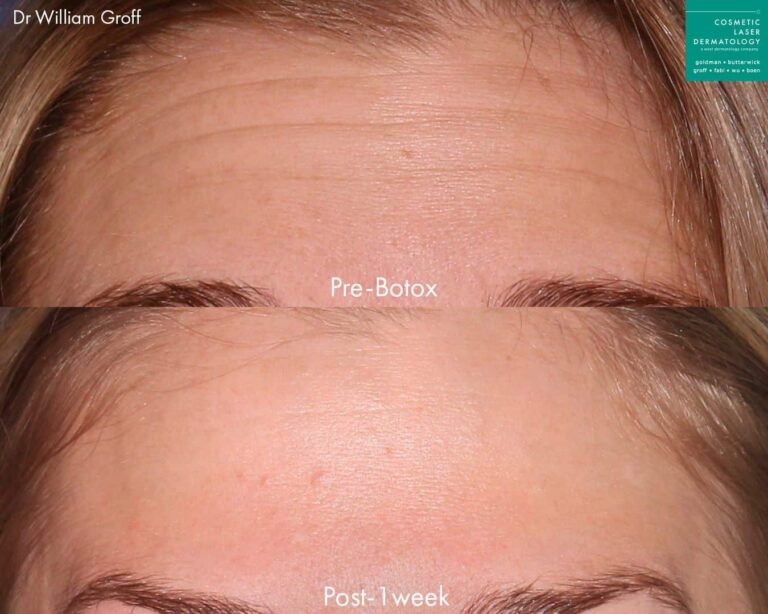 Botox injections used to treat forehead lines on a female patient by Dr. Groff. After treatment, lines are reduced and forehead is visibly smoother.