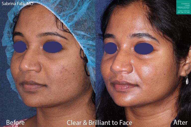 Clear and Brilliant to treat acne on a female patient by Dr. Fabi. After treatment, skin is clearer and brighter.