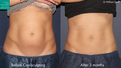 CoolSculpting to reduce abdominal fat and trim the midsection of a female patient by Dr. Groff. After treatment, stomach is flatter and firmer.